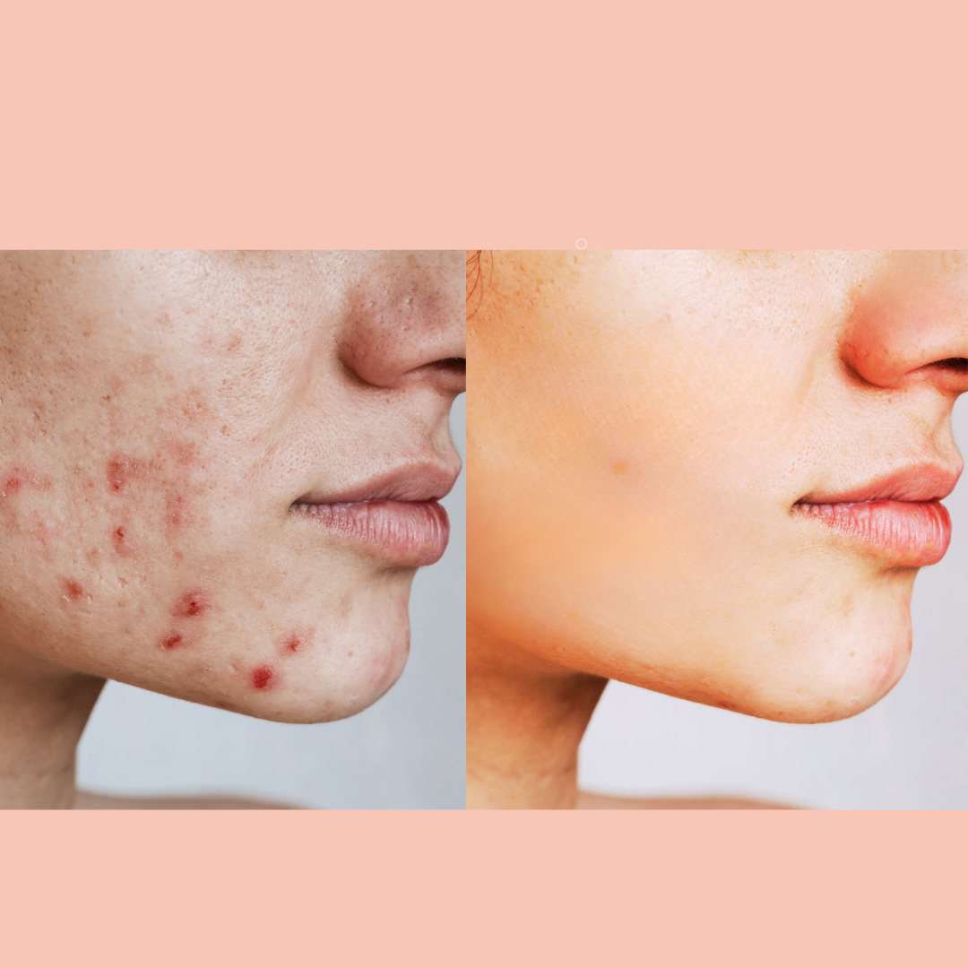 Clear Skin Support
