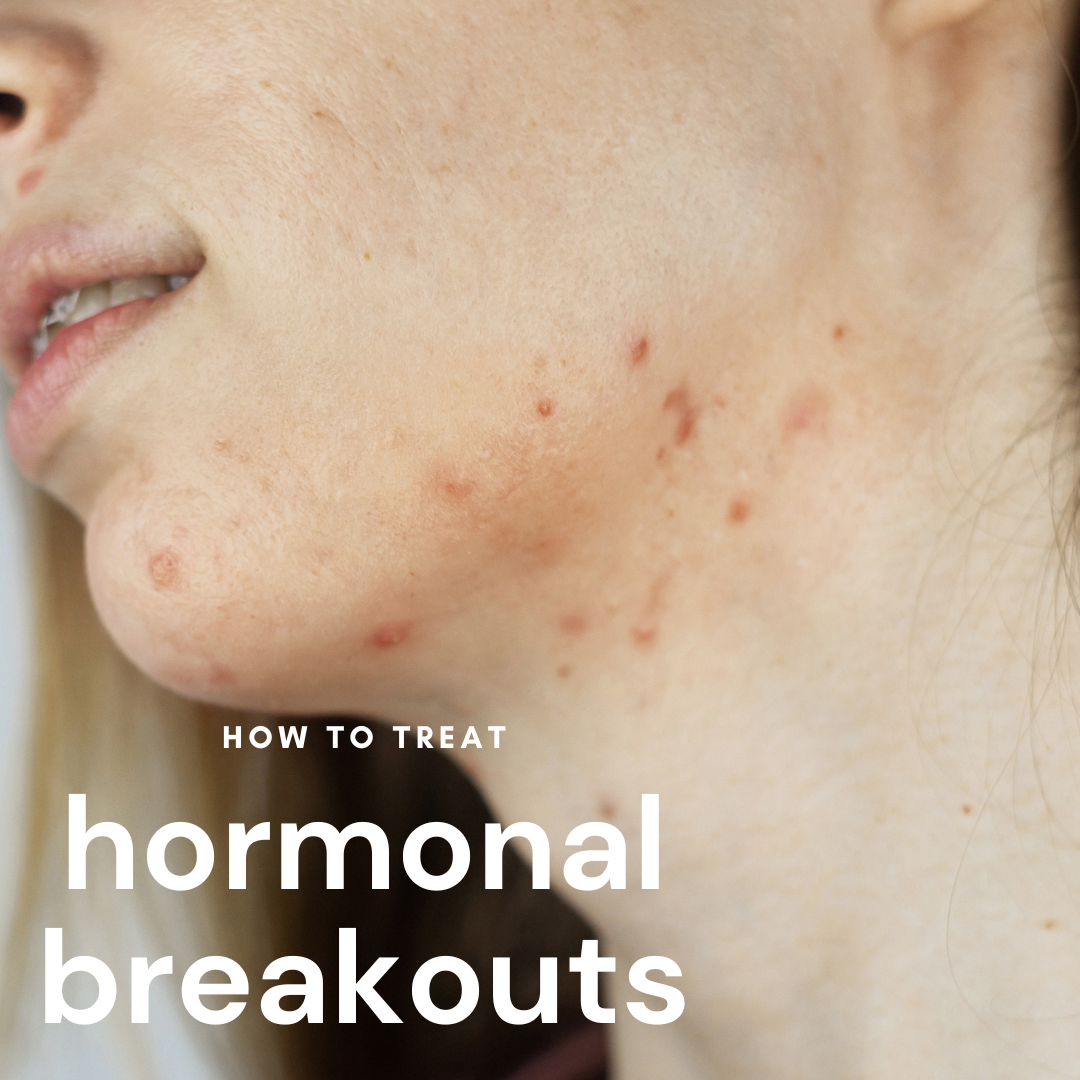 Understanding Hormonal Acne