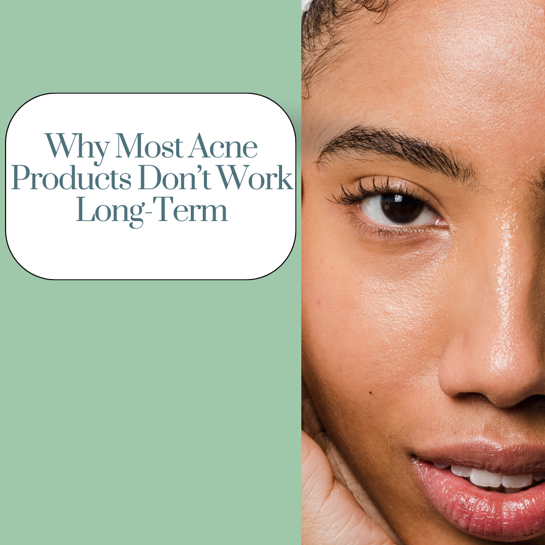 Why Most Acne Products Don’t Work Long-Term (And How We’re Different)