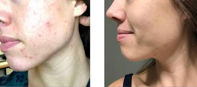 Before-and-after image showing the transformation of acne-prone skin using Freelifer Skincare products