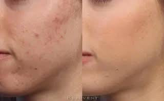 Radiant woman smiling confidently, showcasing smooth, blemish-free skin.