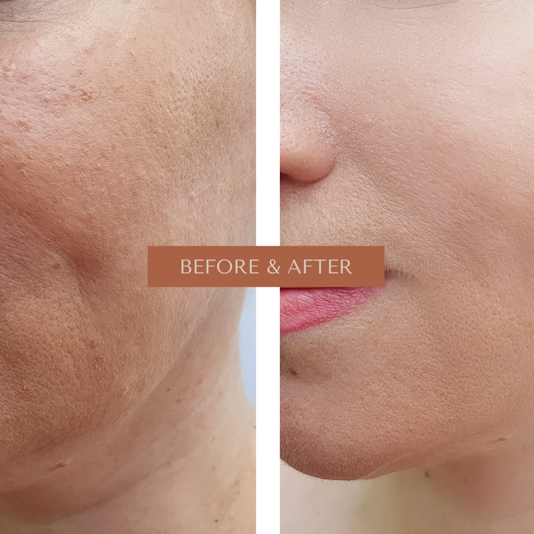 Before-and-after image of a woman’s clear, glowing skin after using Freelifer Skincare products.