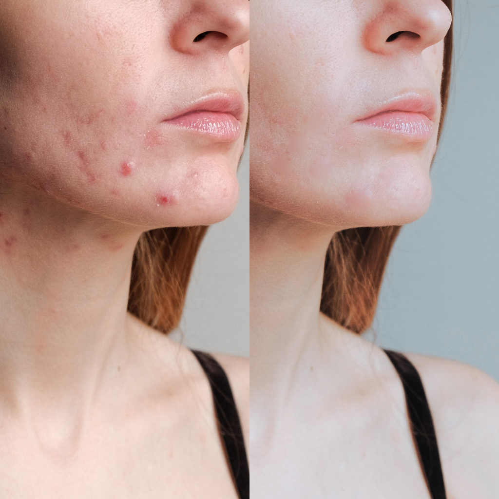 Before-and-after image showing the transformation of acne-prone skin using Freelifer Skincare products