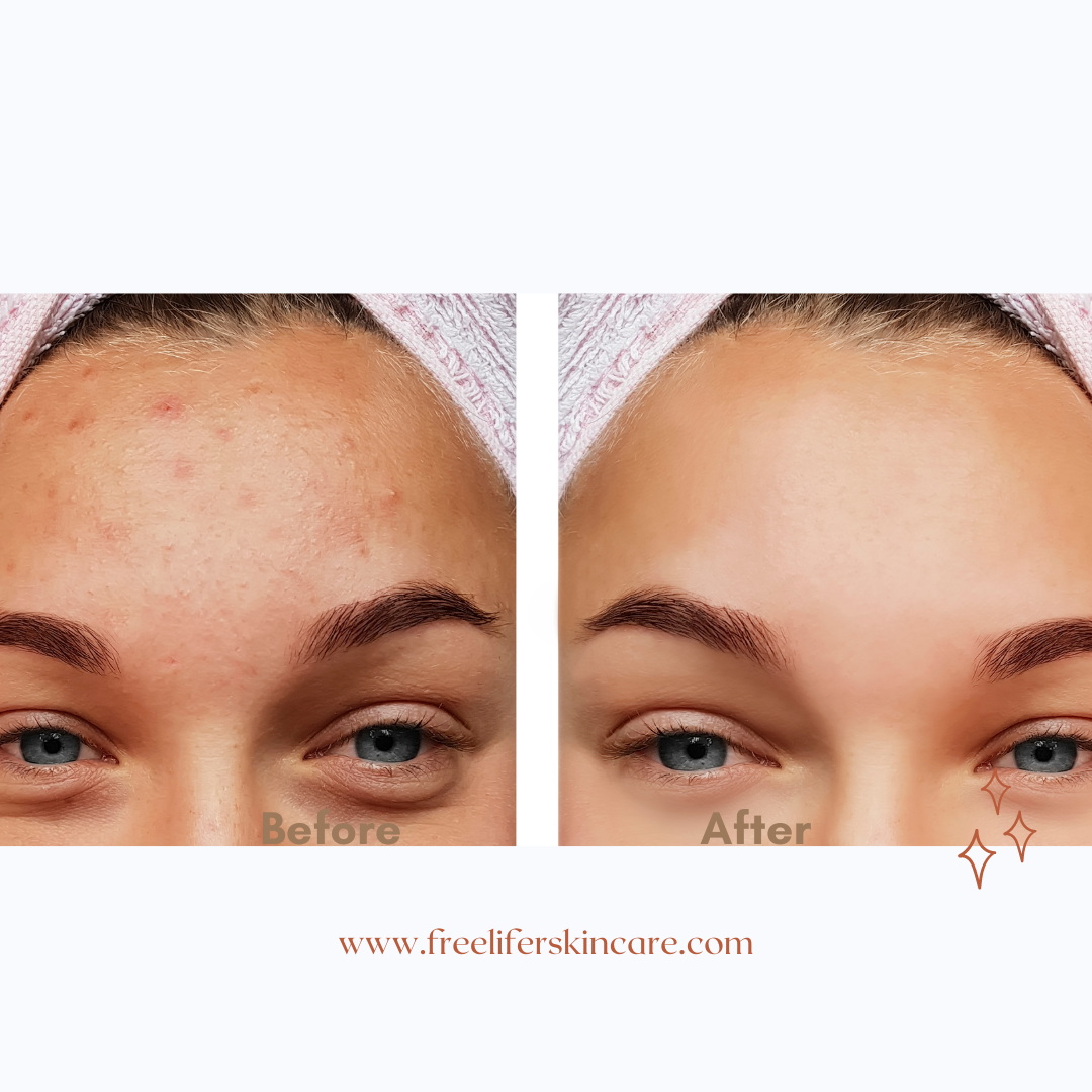 Before-and-after image showing the transformation of acne-prone skin using Freelifer Skincare products